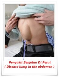 Cara Cepat Menghilangkan Benjolan Di Perut